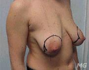 Mastopessi - sollevamento del seno